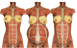 DIÁSTASIS ABDOMINAL