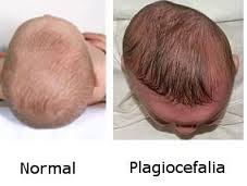 PLAGIOCEFALIA