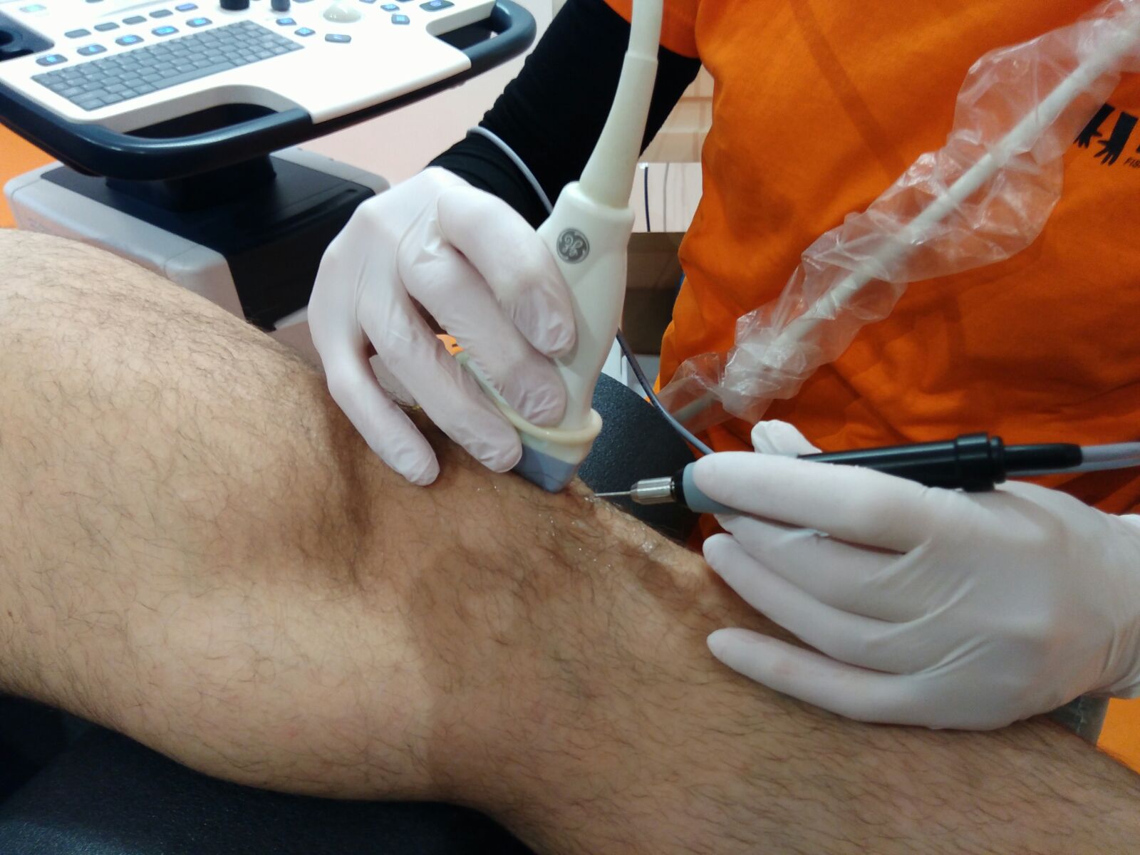 ELECTROLISIS PERCUTÁNEA MÚSCULO-ESQUELÉTICA ECOGUIADA